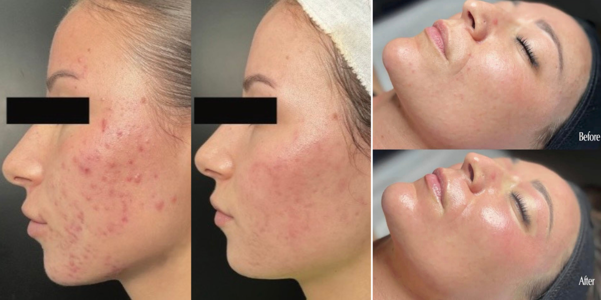 Toskani Meso Needling Before And After (3)